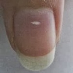 White-spots-on-nails