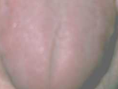 Pale/Swollen Tongue
