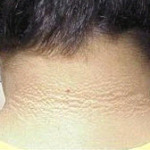 skin back of neck